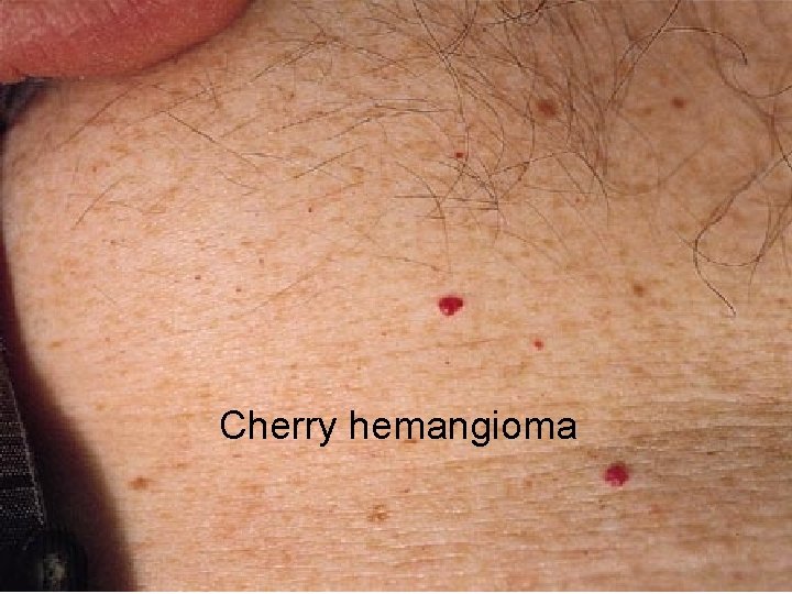 Cherry hemangioma 