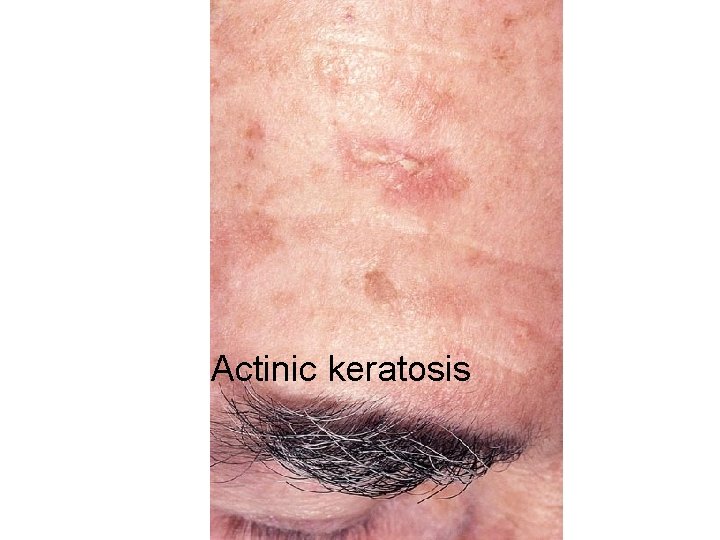 Actinic keratosis 