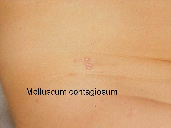 Molluscum contagiosum 