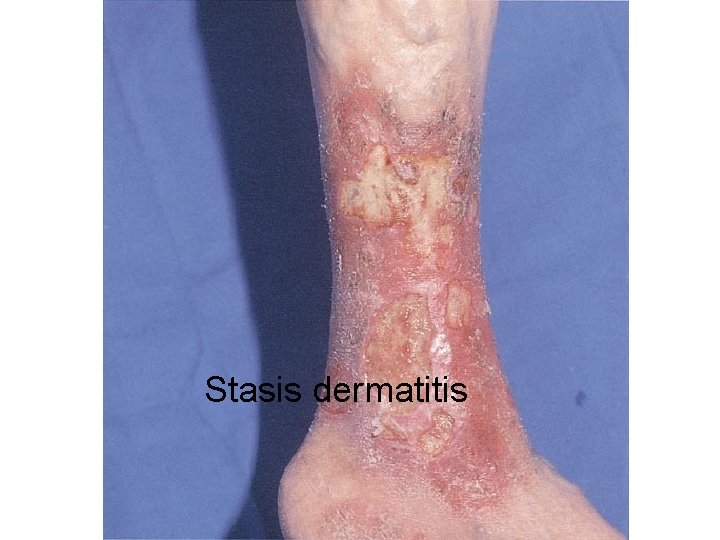 Stasis dermatitis 