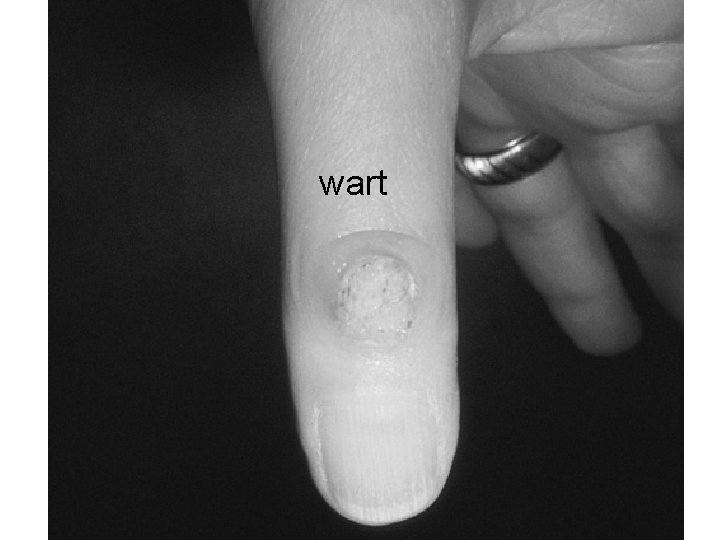 wart 