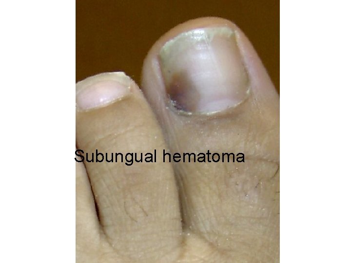 Subungual hematoma 