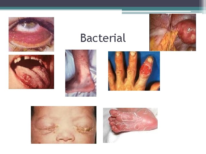 Bacterial 