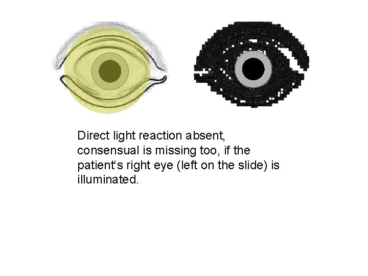 Direct light reaction absent, consensual is missing too, if the patient‘s right eye (left