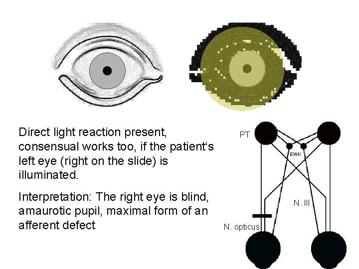 Direct light reaction present, consensual works too, if the patient‘s left eye (right on