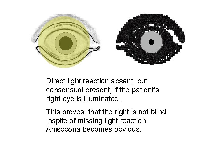 Direct light reaction absent, but consensual present, if the patient‘s right eye is illuminated.