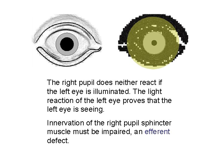 The right pupil does neither react if the left eye is illuminated. The light