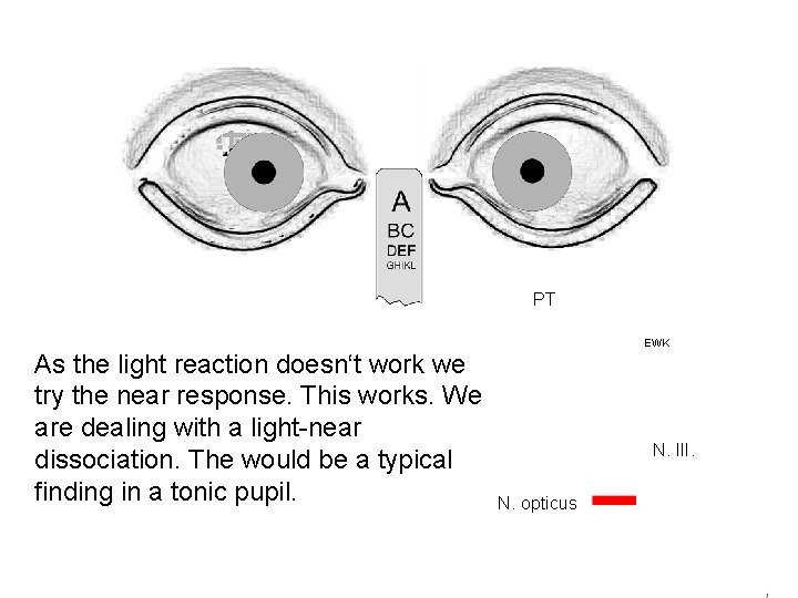 PT As the light reaction doesn‘t work we try the near response. This works.