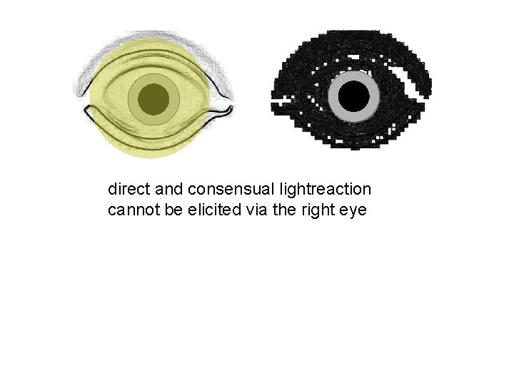direct and consensual lightreaction cannot be elicited via the right eye 