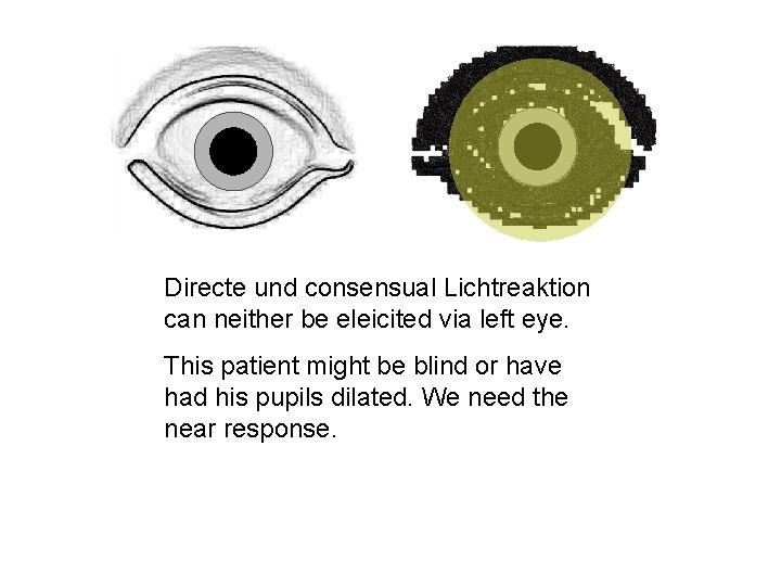 Directe und consensual Lichtreaktion can neither be eleicited via left eye. This patient might