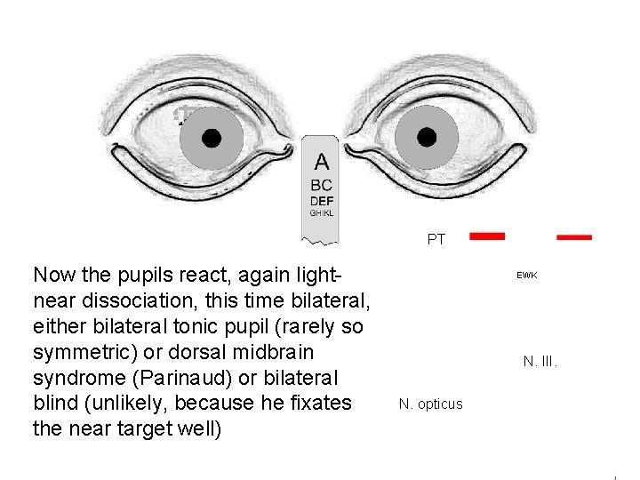 PT Now the pupils react, again lightnear dissociation, this time bilateral, either bilateral tonic