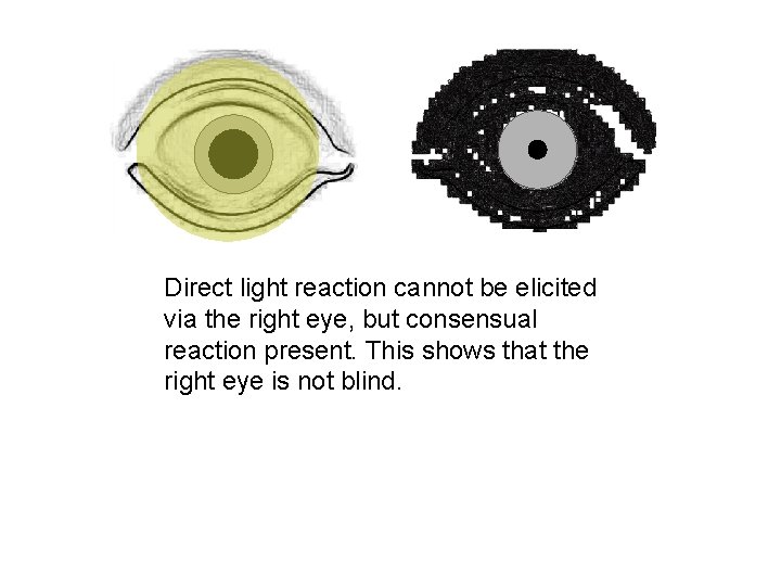 Direct light reaction cannot be elicited via the right eye, but consensual reaction present.