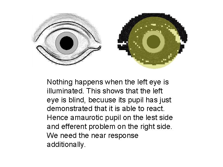 Nothing happens when the left eye is illuminated. This shows that the left eye