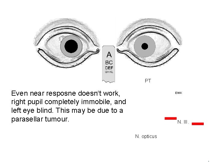 PT Even near resposne doesn‘t work, right pupil completely immobile, and left eye blind.