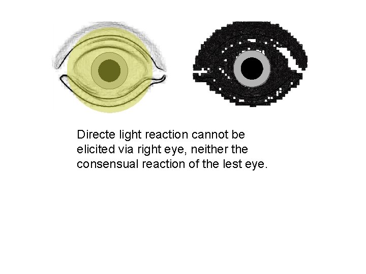 Directe light reaction cannot be elicited via right eye, neither the consensual reaction of