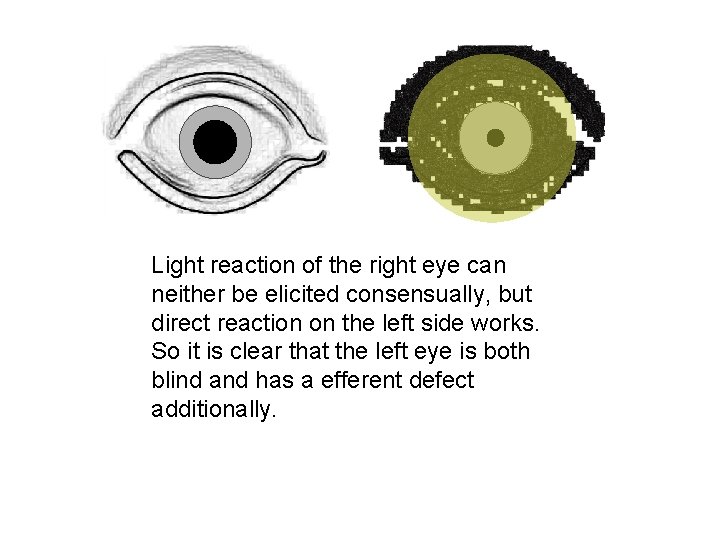 Light reaction of the right eye can neither be elicited consensually, but direct reaction
