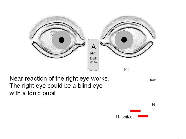 PT Near reaction of the right eye works. The right eye could be a