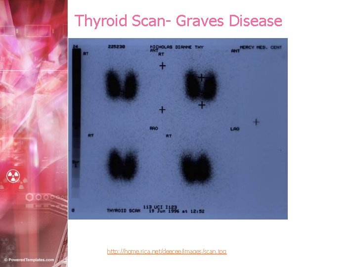 Thyroid Scan- Graves Disease http: //home. rica. net/deecee/images/scan. jpg 