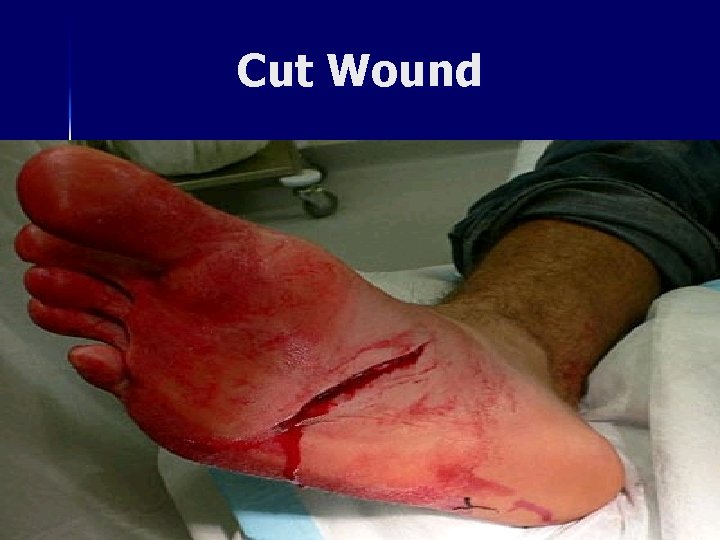 Cut Wound 