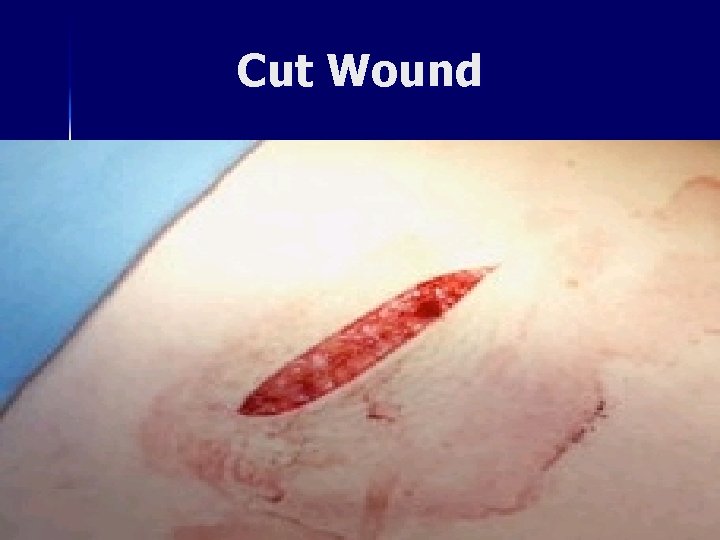 Cut Wound 