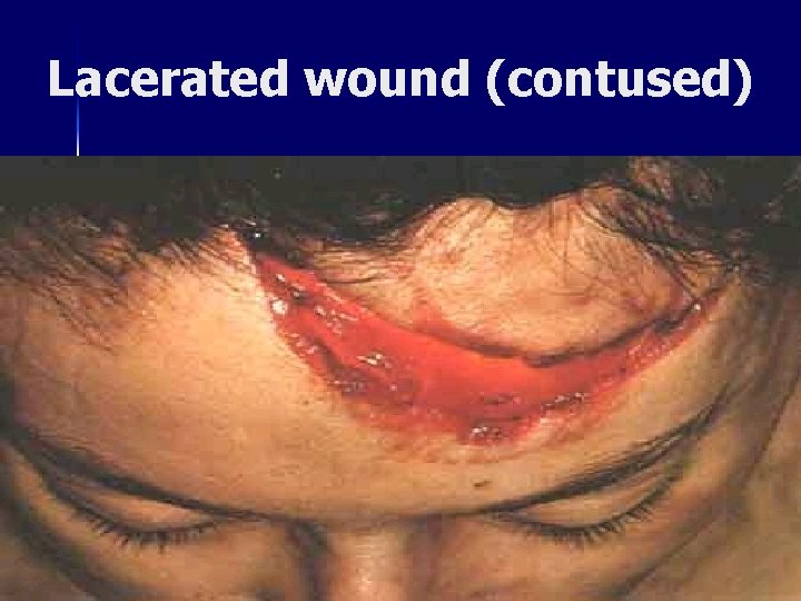 Lacerated wound (contused) 