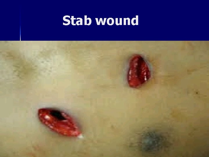 Stab wound 