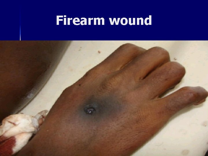 Firearm wound 