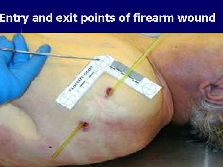 Entry and exit points of firearm wound 