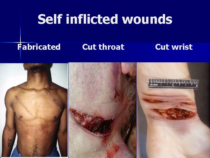 Self inflicted wounds Fabricated Cut throat Cut wrist 