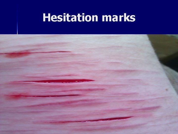 Hesitation marks 