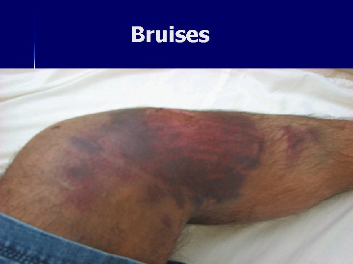 Bruises 