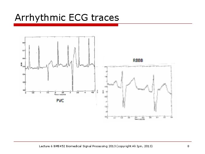 Arrhythmic ECG traces Lecture 6 BME 452 Biomedical Signal Processing 2013 (copyright Ali Işın,