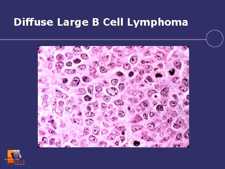 Diffuse Large B Cell Lymphoma 