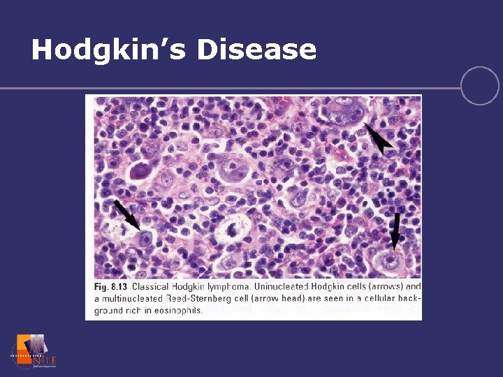 Hodgkin’s Disease 