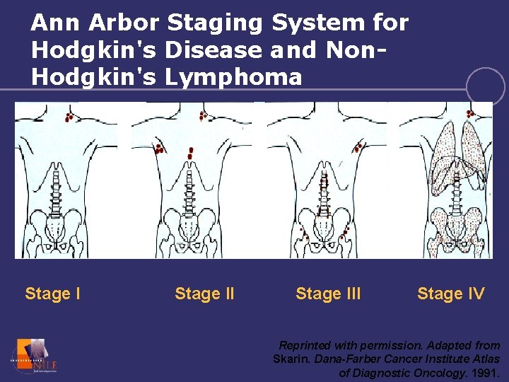 Ann Arbor Staging System for Hodgkin's Disease and Non. Hodgkin's Lymphoma Stage III Stage