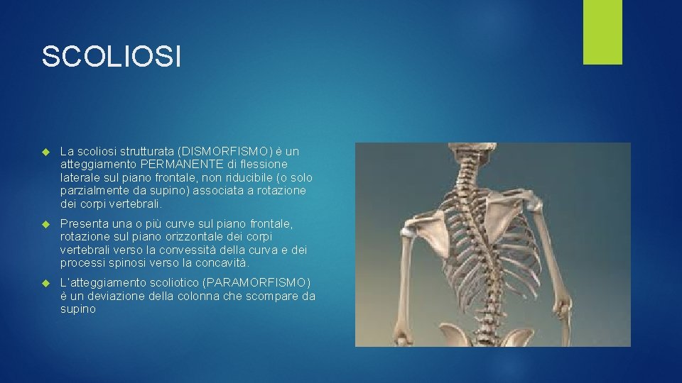 SCOLIOSI La scoliosi strutturata (DISMORFISMO) è un atteggiamento PERMANENTE di flessione laterale sul piano