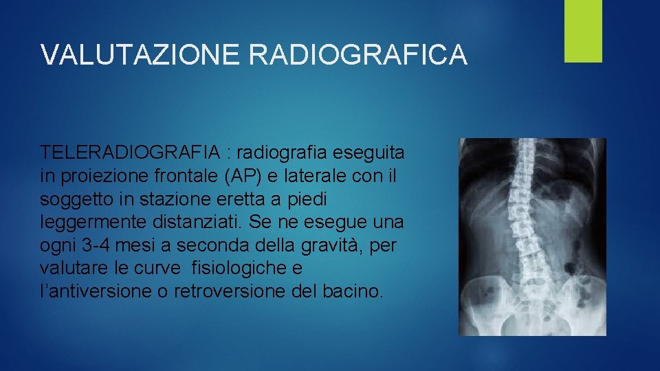 VALUTAZIONE RADIOGRAFICA TELERADIOGRAFIA : radiografia eseguita in proiezione frontale (AP) e laterale con il