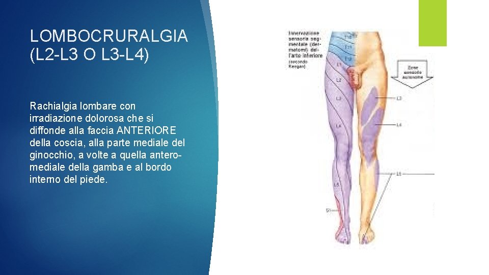 LOMBOCRURALGIA (L 2 -L 3 O L 3 -L 4) Rachialgia lombare con irradiazione
