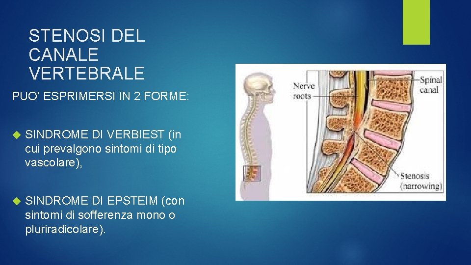 STENOSI DEL CANALE VERTEBRALE PUO’ ESPRIMERSI IN 2 FORME: SINDROME DI VERBIEST (in cui