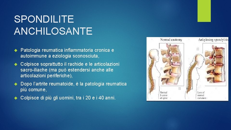 SPONDILITE ANCHILOSANTE Patologia reumatica infiammatoria cronica e autoimmune a eziologia sconosciuta, Colpisce soprattutto il