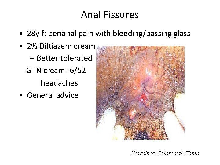 Anal Fissures • 28 y f; perianal pain with bleeding/passing glass • 2% Diltiazem