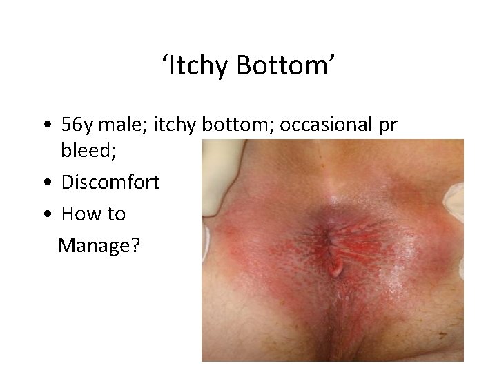 ‘Itchy Bottom’ • 56 y male; itchy bottom; occasional pr bleed; • Discomfort •