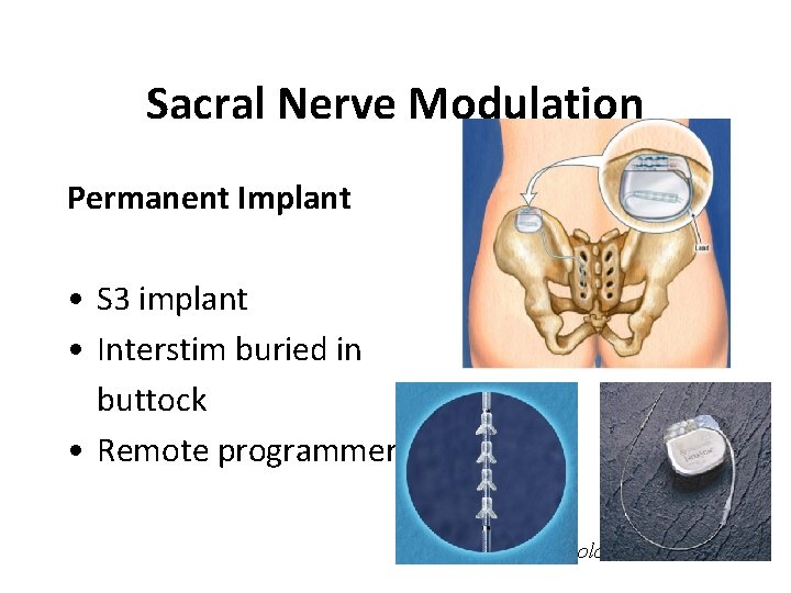 Sacral Nerve Modulation Permanent Implant • S 3 implant • Interstim buried in buttock