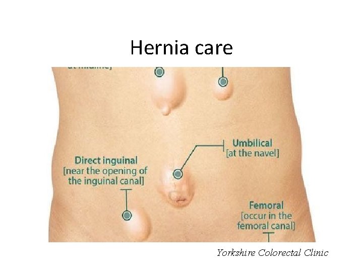 Hernia care Yorkshire Colorectal Clinic 