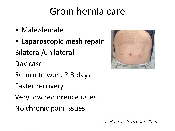 Groin hernia care • Male>female • Laparoscopic mesh repair Bilateral/unilateral Day case Return to