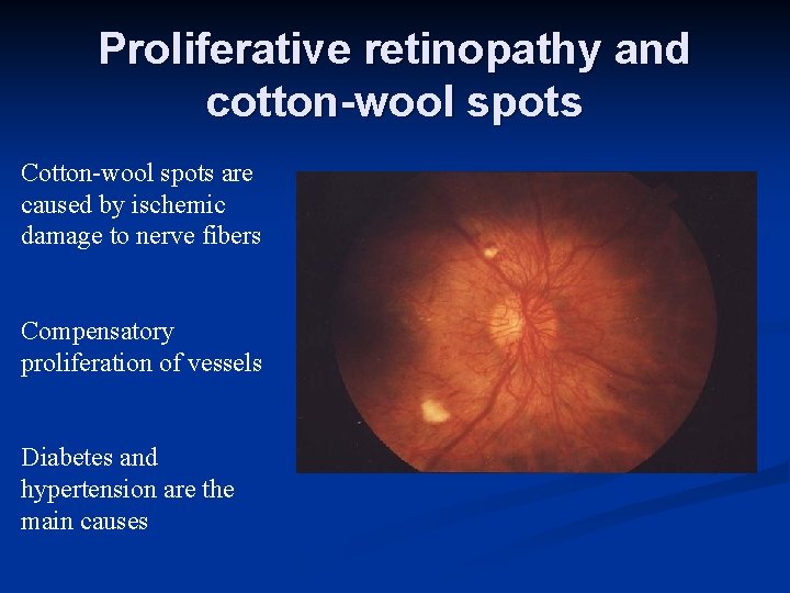 Proliferative retinopathy and cotton-wool spots Cotton-wool spots are caused by ischemic damage to nerve