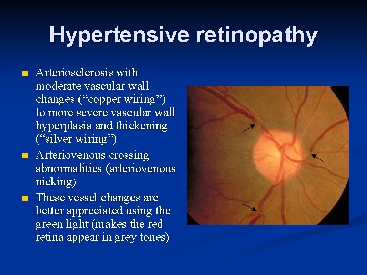 Hypertensive retinopathy n n n Arteriosclerosis with moderate vascular wall changes (“copper wiring”) to
