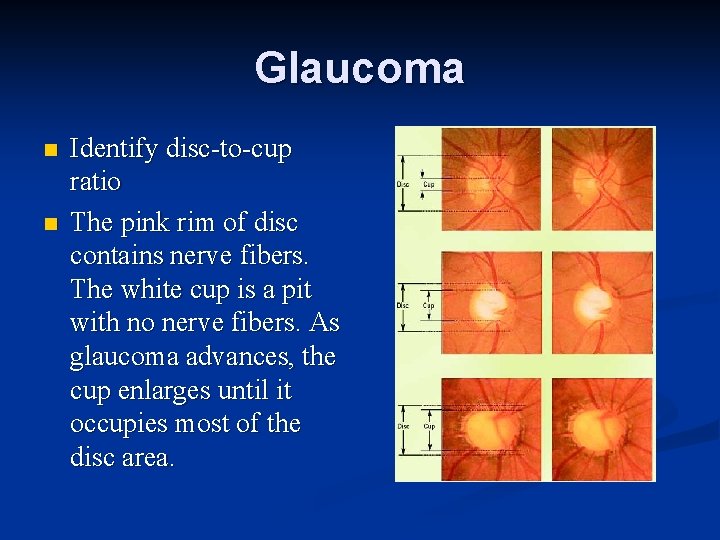 Glaucoma n n Identify disc-to-cup ratio The pink rim of disc contains nerve fibers.