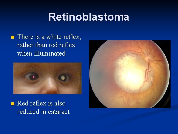 Retinoblastoma n There is a white reflex, rather than red reflex when illuminated n