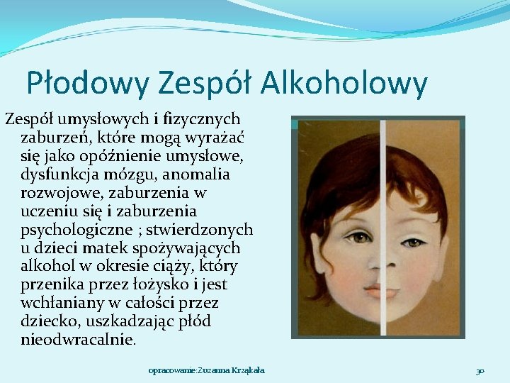 Płodowy Zespół Alkoholowy Zespół umysłowych i fizycznych zaburzeń, które mogą wyrażać się jako opóźnienie